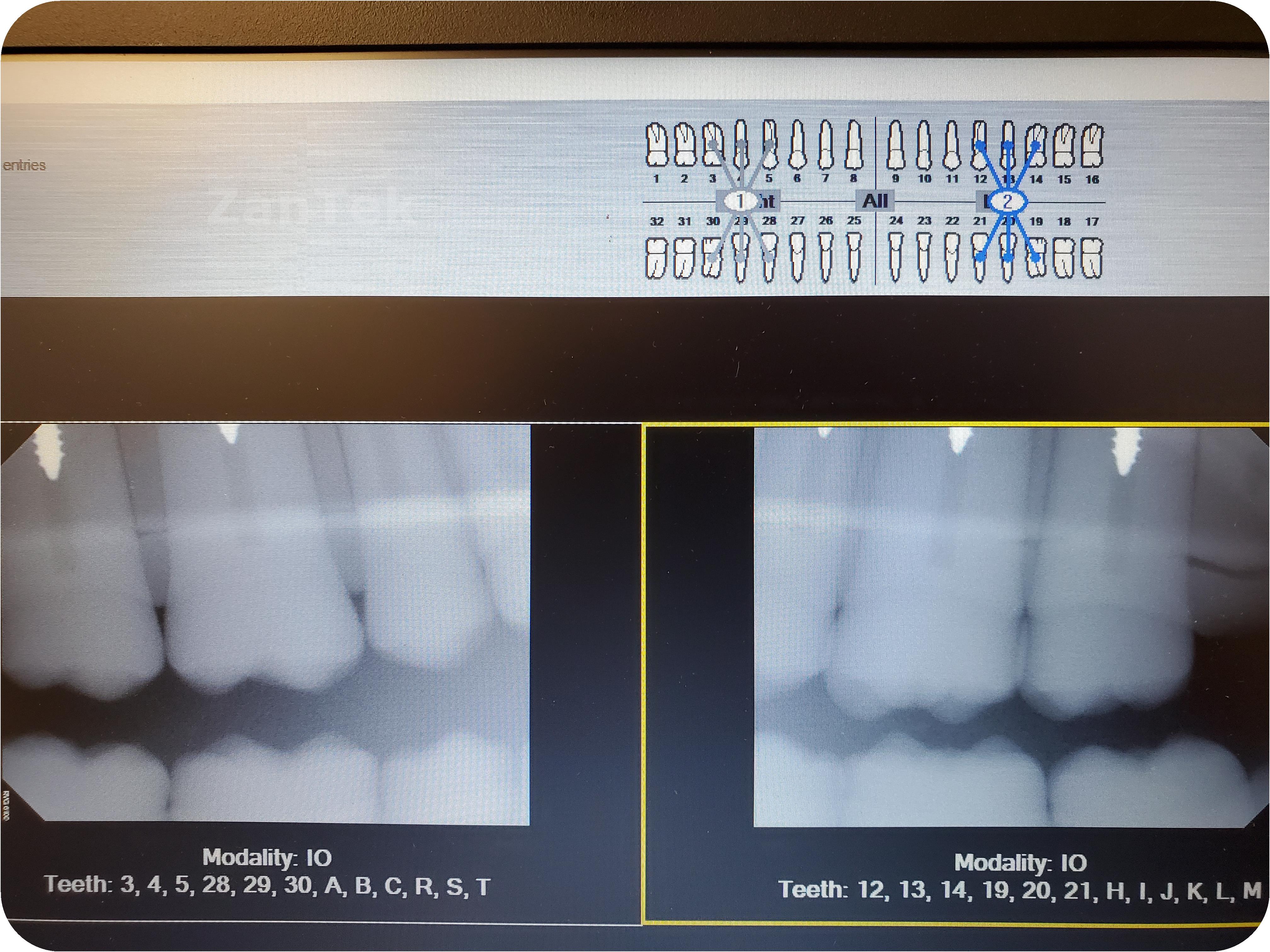 Zantek Medical - 307130-Kodak Carestream RVG 6100 Size 2 Digital Dental ...